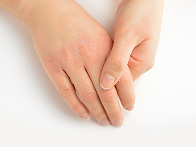 Totul despre alergiile dezvoltate in procesul de manichiura: cauze si sfaturi utile